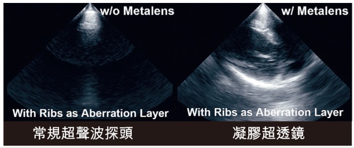 「動態控制超透鏡」（MetaLens）透過微細結構，能精準調控超聲波的傳播路徑及相位，使其有效穿透肋骨，同時大幅減少聲波反射與散射。